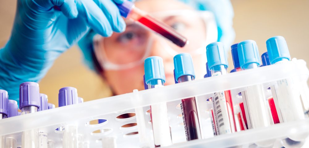 Blood Test Ably Identifies Ovarian Cancer Prior to Surgery, Clinical Trial Planned