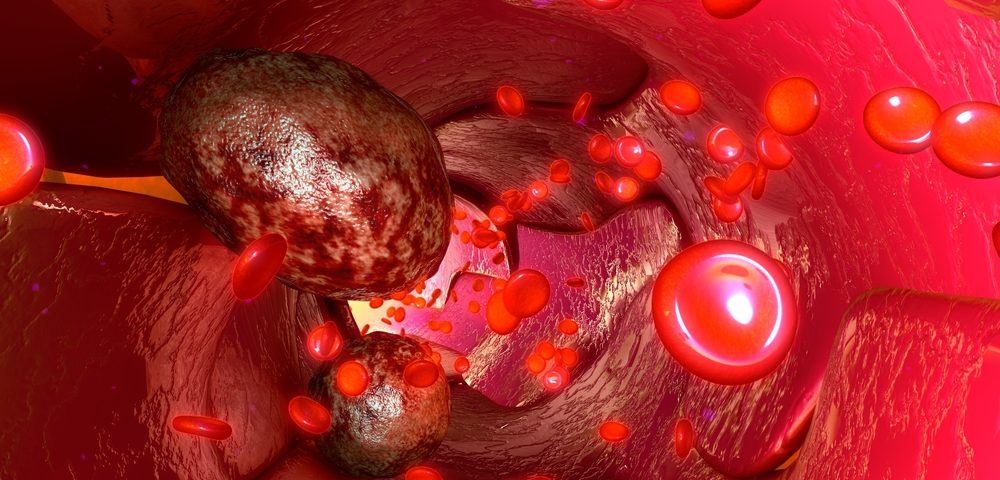Study Analyzes Use of Circulating Tumor Cells as Prognostic Marker in Ovarian Cancer