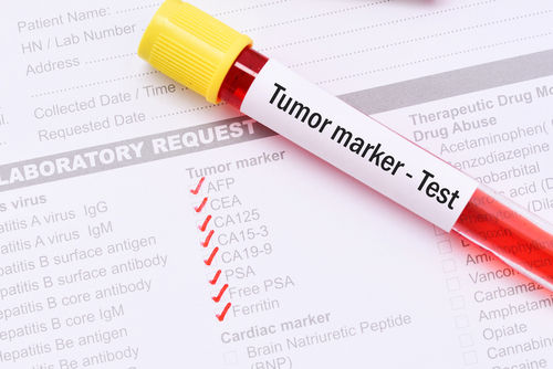 CA125 Blood Test Useful in Diagnosing Ovarian Cancer in Routine Setting