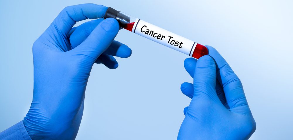 Bacterial Toxin-based Test Could Help Detect Ovarian Cancer Early
